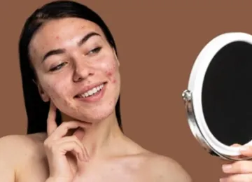 Graus de acne: tipos de lesões, gravidade e tratamentos