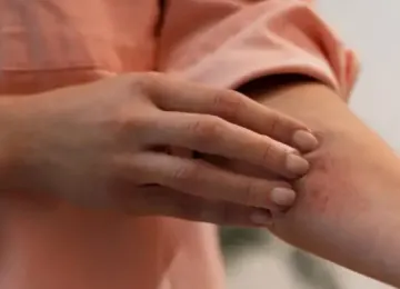 O que é e como cuidar de uma erupção cutânea (ou na pele)?